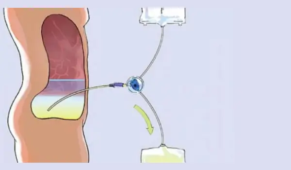 Colocación de catéter para Diálisis peritoneal en Culiacán, Sinaloa