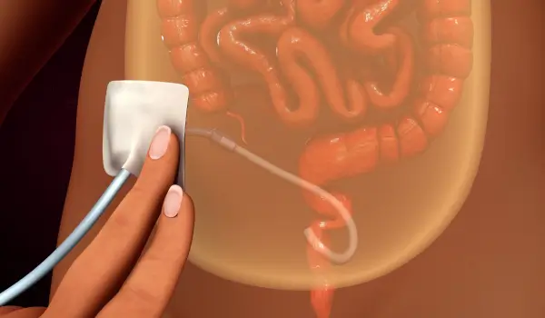  Precio de Consulta de Diálisis Peritoneal en Culiacán, Sinaloa